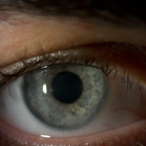 Read more about the article An update on intracorneal ring segments