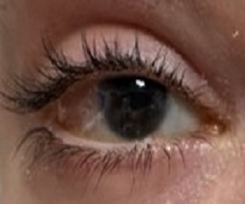 Slit lamp photos of the right eye. A: Baseline ankyloblepharon; the visual acuity was hand motion; B: Ocular surface of the right eye 6 months after the surgery after B-VEC applications Source: Krystal Biotech