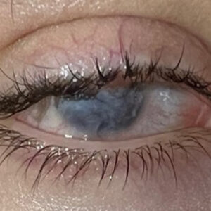 Read more about the article Topical gene therapy for rare ocular surface condition