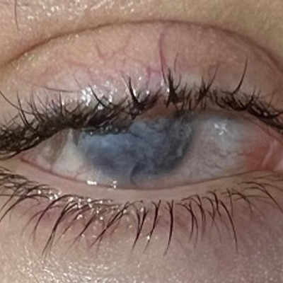 Read more about the article Topical gene therapy for rare ocular surface condition