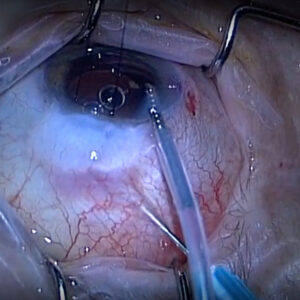 Read more about the article Complications in cataract surgery with a functioning trabeculectomy