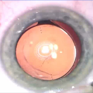 Read more about the article Toric troubles: postop rotation