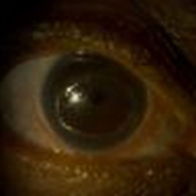 Read more about the article Addressing neurotrophic keratitis