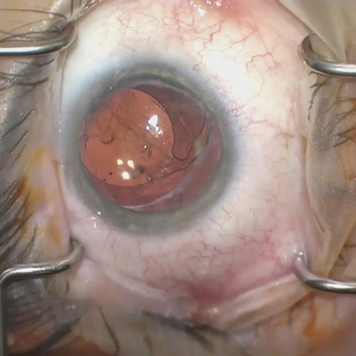 Read more about the article Assessing IOL tilt and decentration