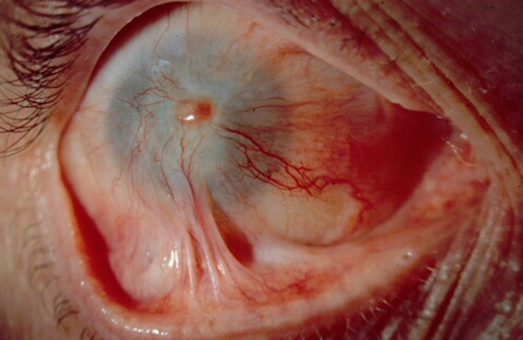 Chemical injury with conjunctival scarring, total limbal stem cell deficiency and failed PK