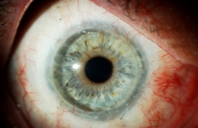 Twenty years postop after a living-related conjunctival limbal allograft and keratolimbal allograft Source (all): Edward Holland, MD.