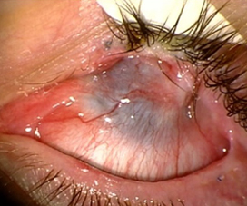 Chemical injury with severe symblepharon and total limbal stem cell deficiency