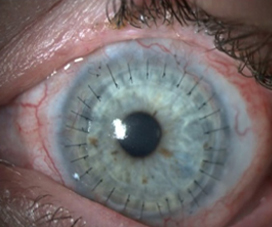 Two years postop after a living-related conjunctival limbal autograft and keratolimbal allograft with subsequent PK