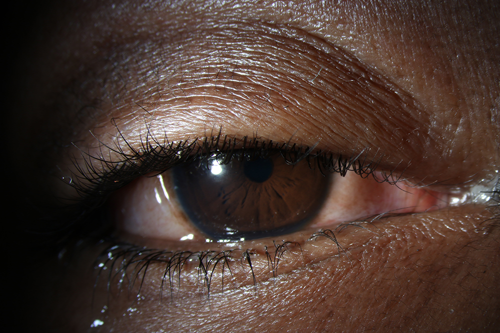 Foreign objects, such as contact lenses or even bugs, can get stuck in the eye or under the eyelid, causing FBS. Source: Rony Sayegh, MD