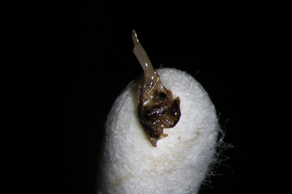 Foreign objects, such as contact lenses or even bugs, can get stuck in the eye or under the eyelid, causing FBS. Source: Rony Sayegh, MD