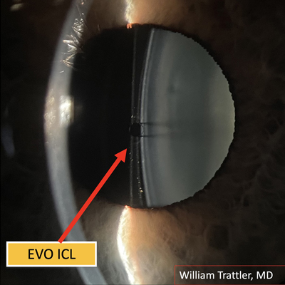 Dr. Trattler says with use of the LASSO formula he has felt comfortable implanting ICLs in patients below the 3.0 mm, on-label ACD indication. Source: William Trattler, MD