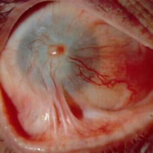 Read more about the article Physician perspective: Why are cornea specialists failing patients with limbal stem cell deficiency?