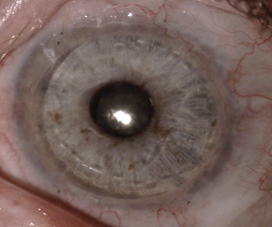 Sixteen years postop after a living-related conjunctival limbal autograft and keratolimbal allograft with subsequent PK