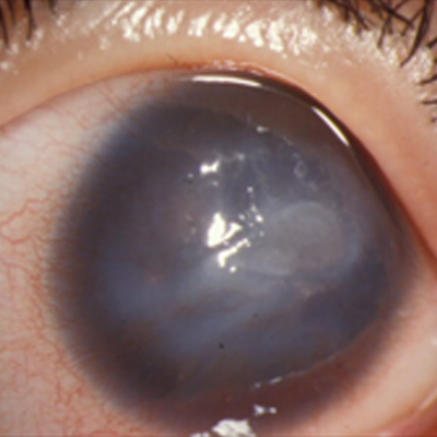 Aniridic keratopathy and total limbal stem cell deficiency—preoperative photo of the right eye