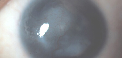 Aniridic keratopathy and total limbal stem cell deficiency—preoperative photo of the left eye