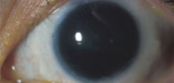 Aniridic keratopathy and total limbal stem cell deficiency—right eye 15 year postop after a keratolimbal allograft