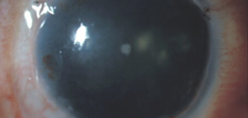Aniridic keratopathy and total limbal stem cell deficiency—left eye 14 years postop after keratolimbal allograft Source (all): Edward Holland, MD