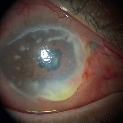 Right eye of 51-year-old woman with bilateral peripheral ulcerative keratitis associated with granulomatosis with polyangiitis Source: Sanjay Kedhar, MD
