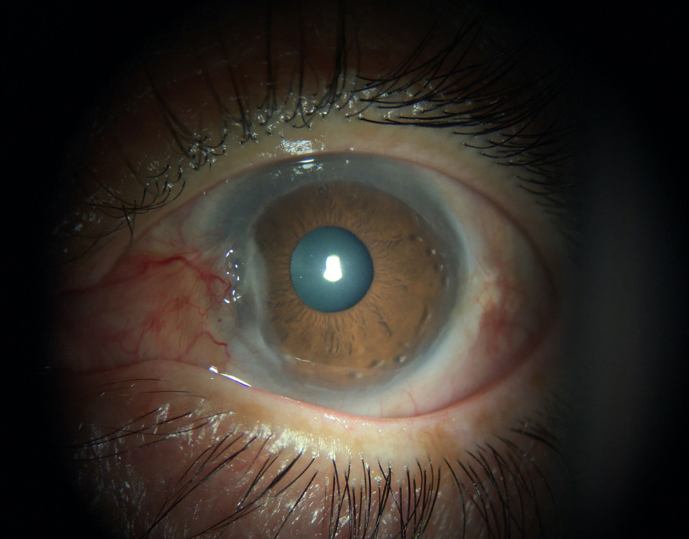 Left eye of 51-year-old woman with bilateral peripheral ulcerative keratitis associated with granulomatosis with polyangiitis
Source: Sanjay Kedhar, MD