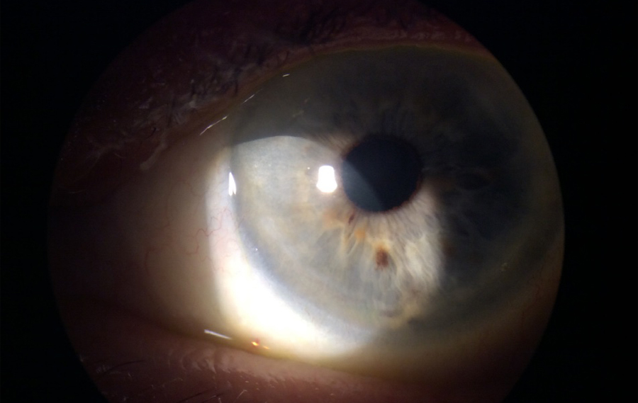 A 79-year-old with a history of psoriasis, not on any immunomodulatory therapy, presented with a crescent-shaped ulcer at the limbus. After treatment with oral steroids, the patient had complete resolution of the corneal infiltrate and epithelial defect. Source: Ashraf Ahmad, MD