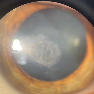 Read more about the article Antiviral treatment for HSV