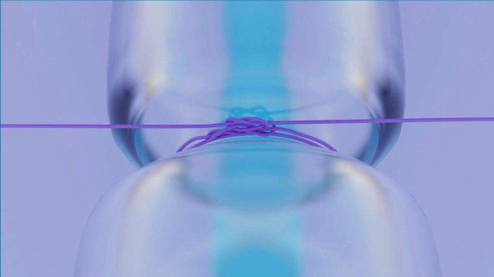 In the session, Dr. Provencher discussed her “OctoKnot” non-valved tube occlusion technique (shown here) for how to occlude a non-valved tube to get a watertight closure. Source: Lorraine Provencher, MD