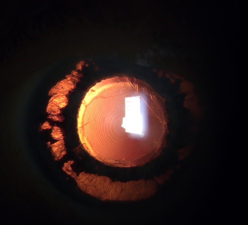 This is an example of midperipheral transillumination defects from a multifocal IOL causing UGH syndrome. The patient underwent IOL exchange with resolution of inflammation. Source: Allison Chen, MD