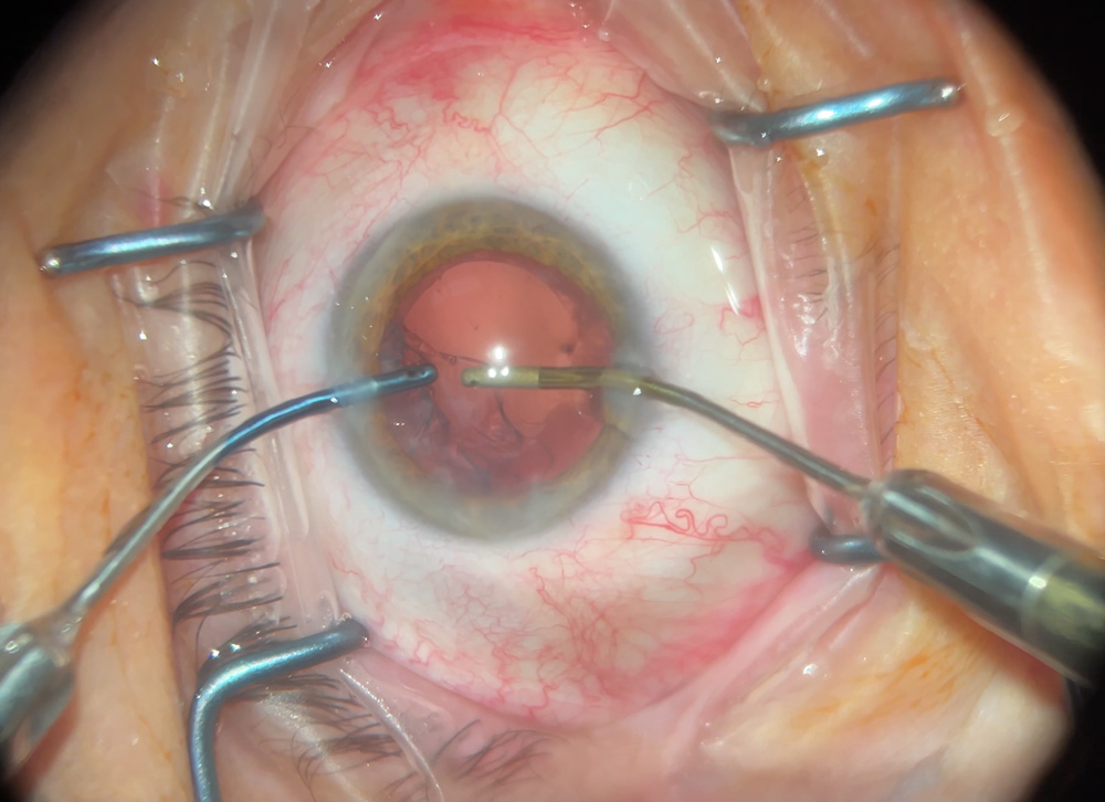Bimanual I/A is shown here.
Source: Cristos Ifantides, MD, MBA