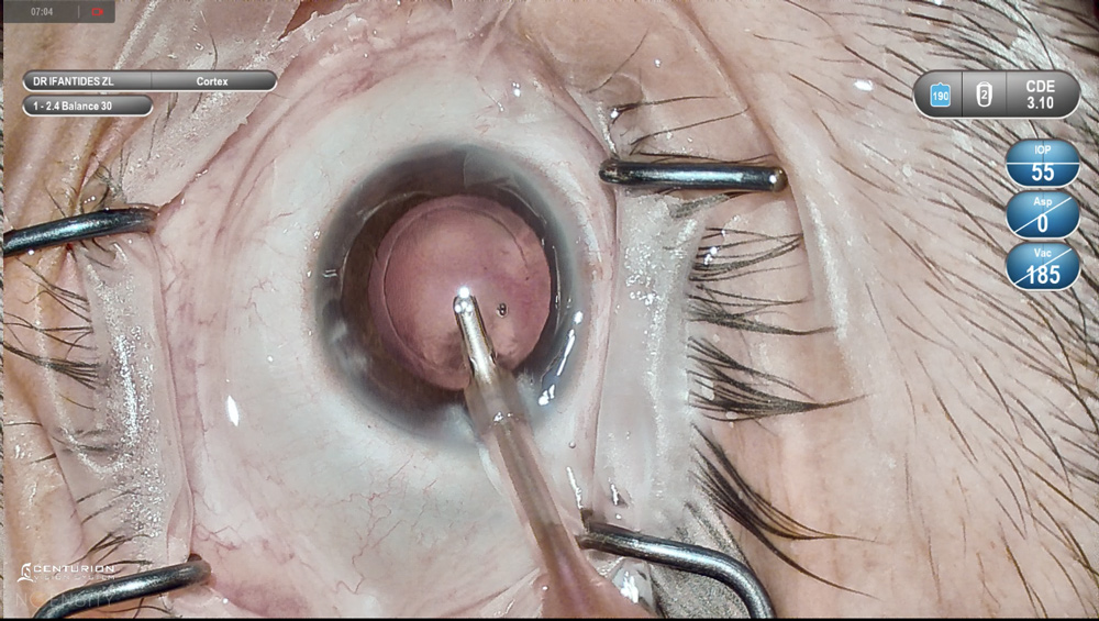 Coaxial I/A is shown here. Source: Cristos Ifantides, MD, MBA