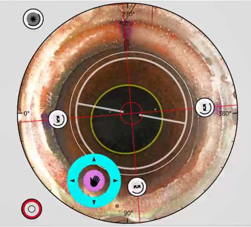 Intraoperative view of semi-automated manual adjustment of the lenticule following suction application
Source: Jod Mehta, MD