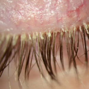 Read more about the article Wish granted: more ocular surface options