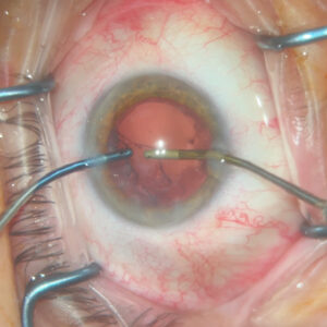 Read more about the article Comparing bimanual and coaxial I/A