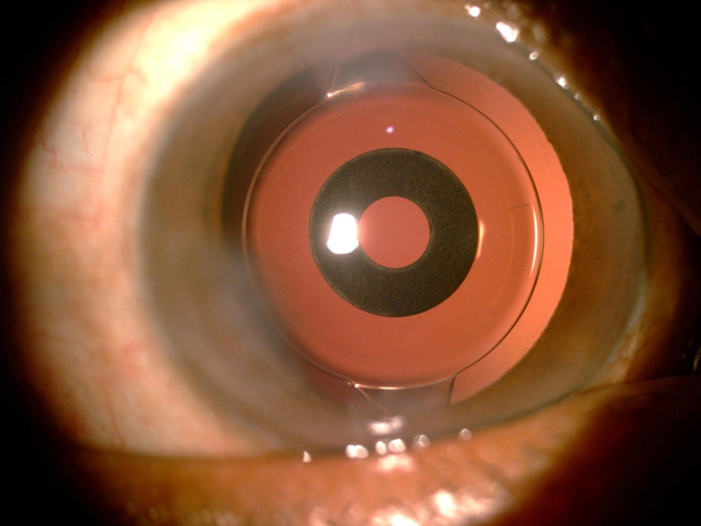 IC-8 Apthera IOL in a post-LASIK eye
Source: Robert Ang, MD