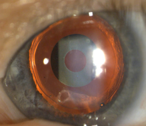 Nd:YAG posterior capsulotomy image of the intentional hinge left from 5–7 o’clock Source: Nicole Fram, MD