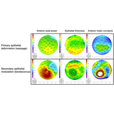 Read more about the article Epithelial mapping: applications for residual refractive error and current technology