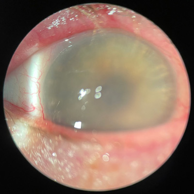 Read more about the article What’s causing an ‘uptick’ in primary graft failures?