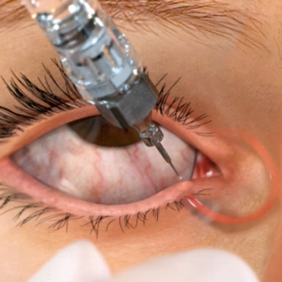 Read more about the article Punctal occlusion: a valuable resource for dry eye patients