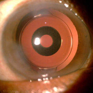 Read more about the article On- and off-label indications for small aperture technology