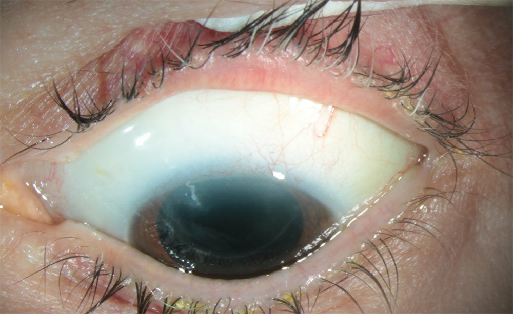 Diffuse XEN bleb 2 years after ab interno implant approach with primary trimming and needling; IOP 9 mm Hg without drops
Source: Ang Li, MD