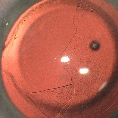 Read more about the article Cataract surgery in eyes with endothelial damage