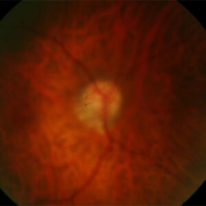 Read more about the article Floaters getting in the way of postop patient happiness?