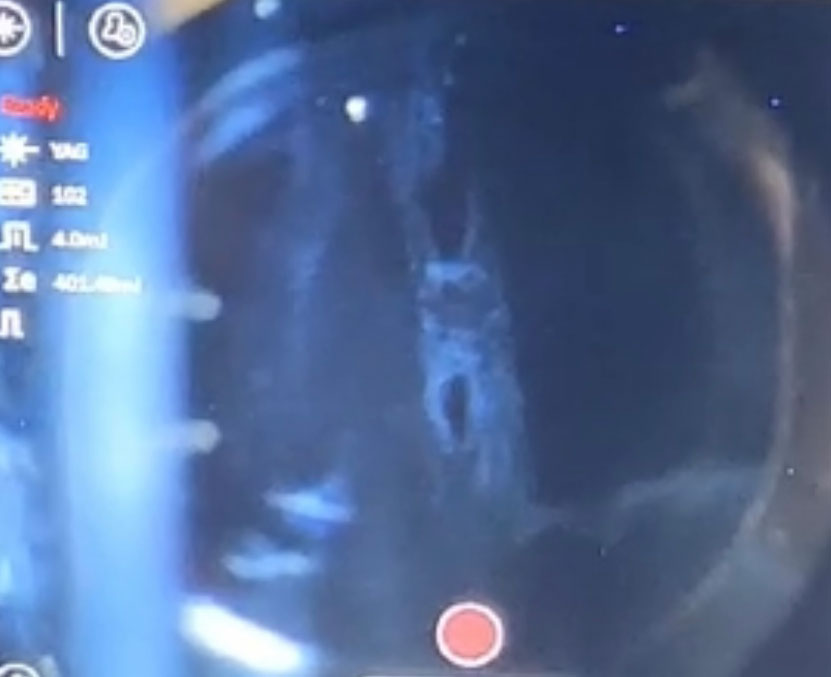 Vitreous veil with a small hole created at the beginning of a YAG laser session
Source: Dagny Zhu, MD