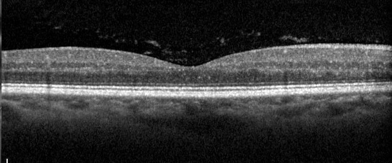 Vitreous condensation (opacities, floaters) Source: Mohammad Rafieetary, OD