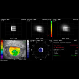 Read more about the article The impact of HOAs on refractive options and outcomes