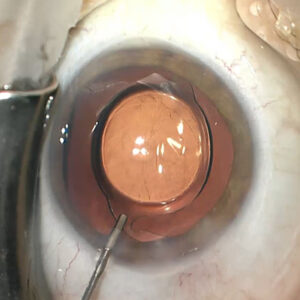 Read more about the article Allergies or intolerance to materials used in cataract surgery