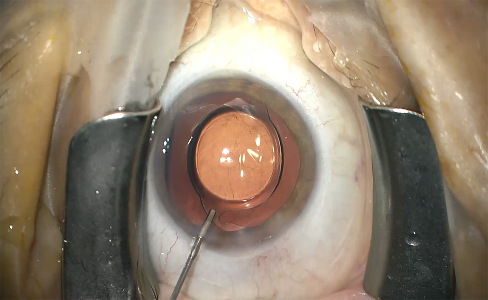 Dr. DelMonte injects intracameral moxifloxacin at the end of cataract surgery to prevent endophthalmitis. He prefers to use intracameral antibiotics even in cases of a reported systemic allergy to a similar medication due to the unique immune response inside the eye and the known benefit of this practice.
Source: Derek DelMonte, MD