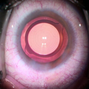 Read more about the article A shift toward RLE