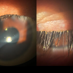 Read more about the article Expanded treatment options in dry eye