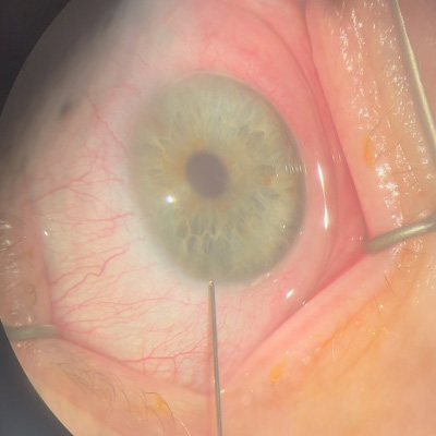Read more about the article Corneal cell therapy: current status and looking to the future