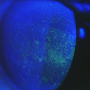 Read more about the article Preservatives in ophthalmic medications and alternative strategies